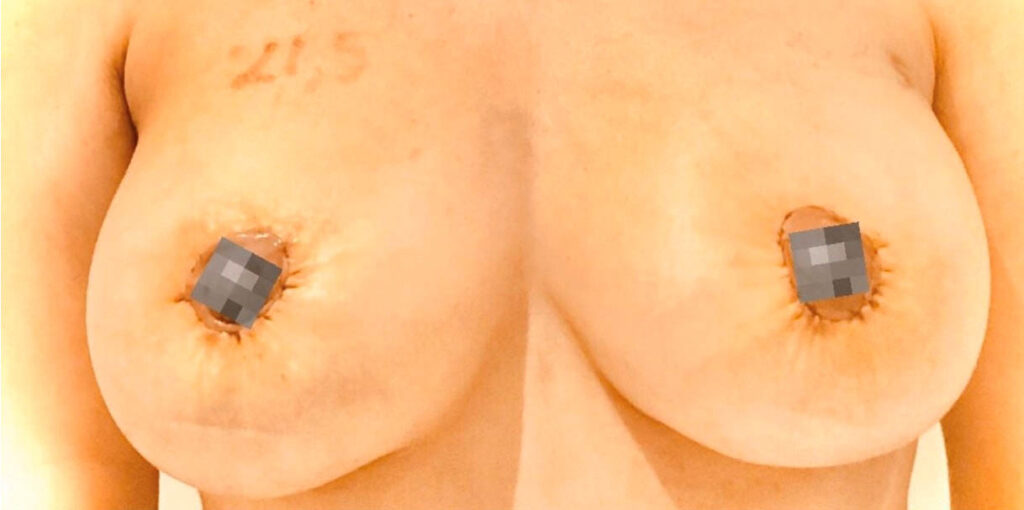 bröstlyft-efter-sasclinic