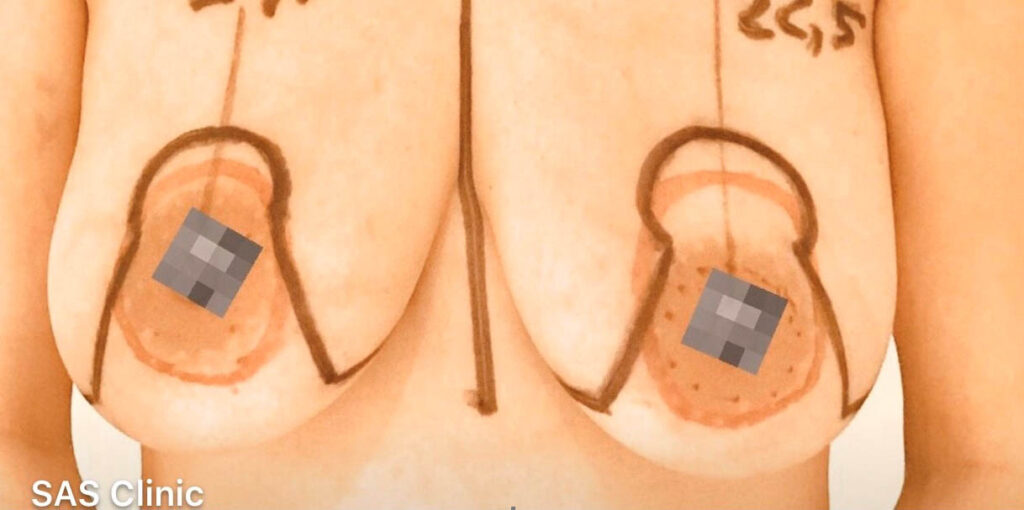 bröstlyft-före-sasclinic